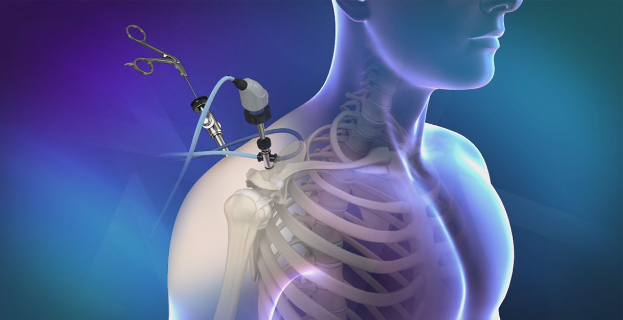 shoulder-arthroscopy